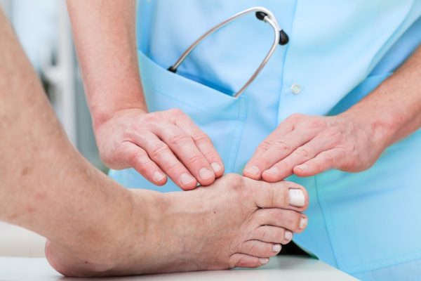 Fort Myers Podiatrist Bunion Treatment