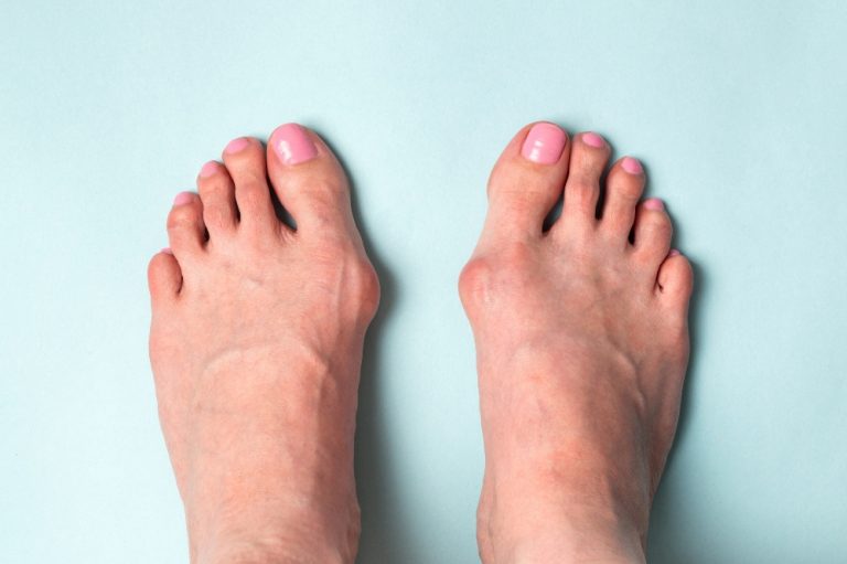 Bunions & Runners How to Prevent and Safely Run with Bunions
