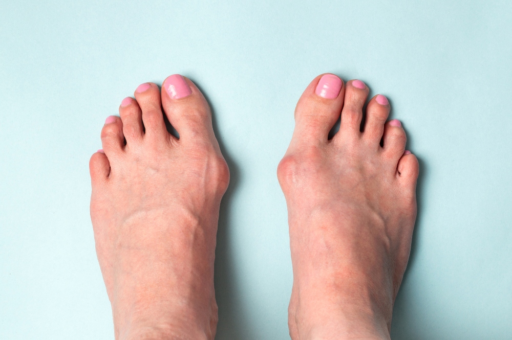 Bunion Treatment Fort Myers Podiatrist