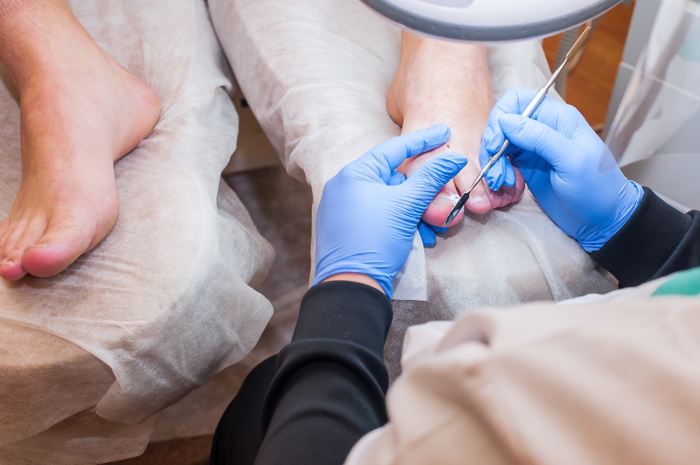 Ingrown Hair Treatment Fort Myers Podiatrist