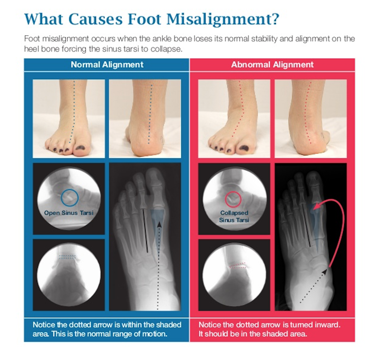 Misaligned Feet