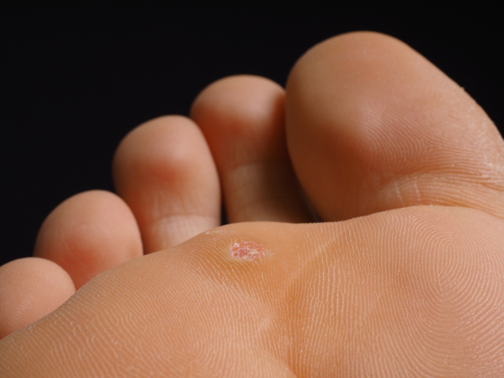 Plantar warts