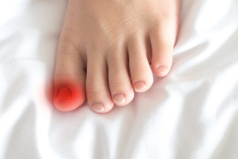 Signs Your Ingrown Toenail Is Infected Southwest Florida Podiatrist
