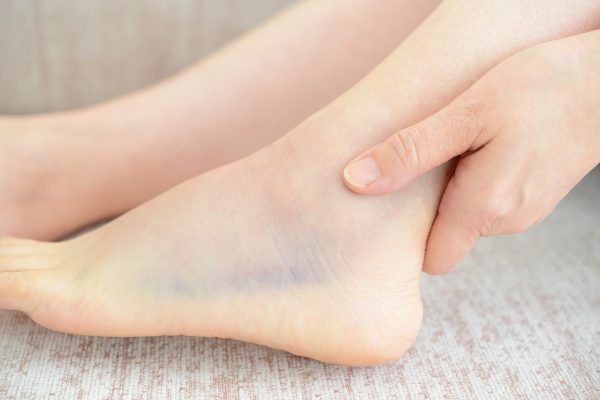 stress fracture