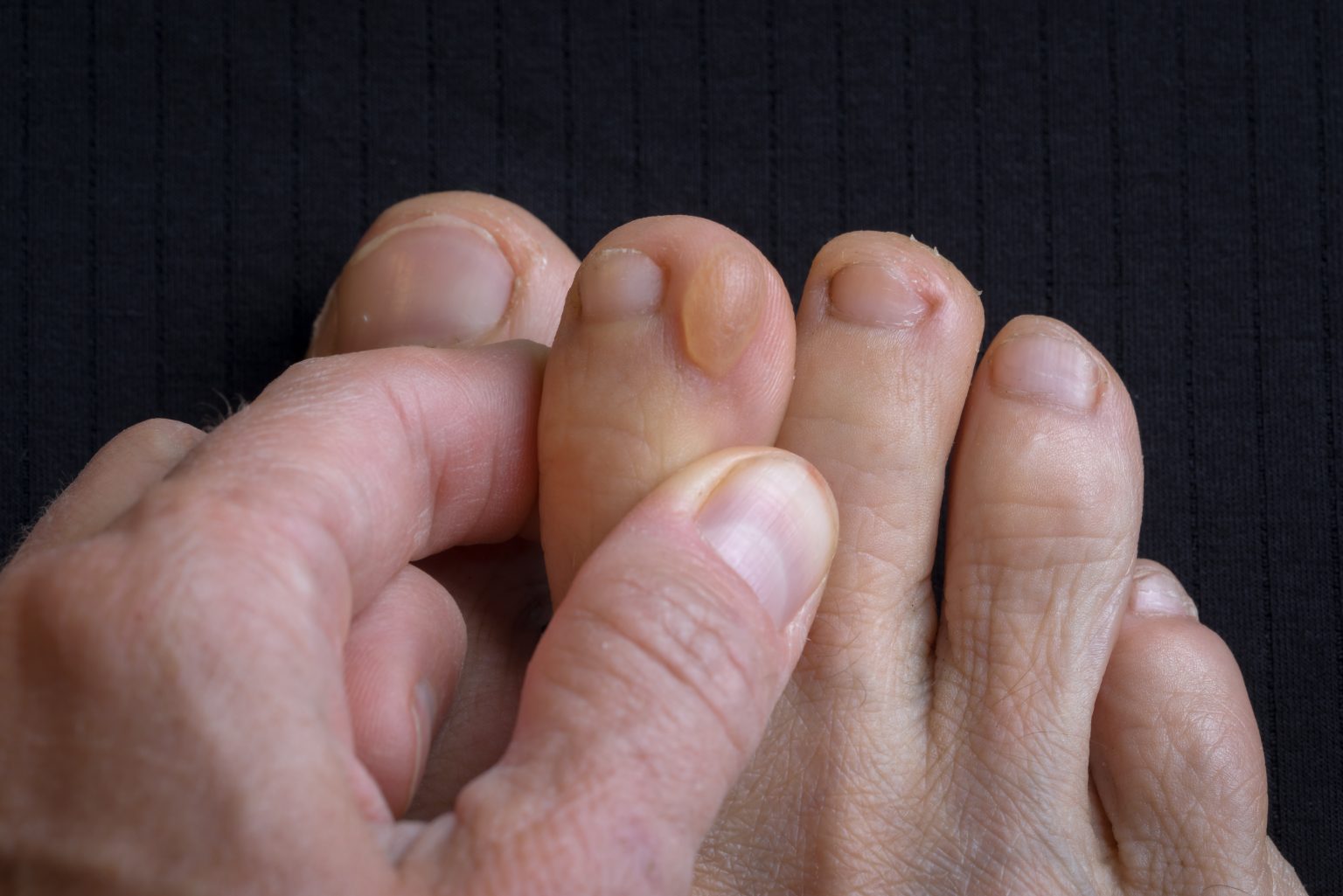 What’s the Difference Between Foot Corns vs Foot Calluses? Foot and