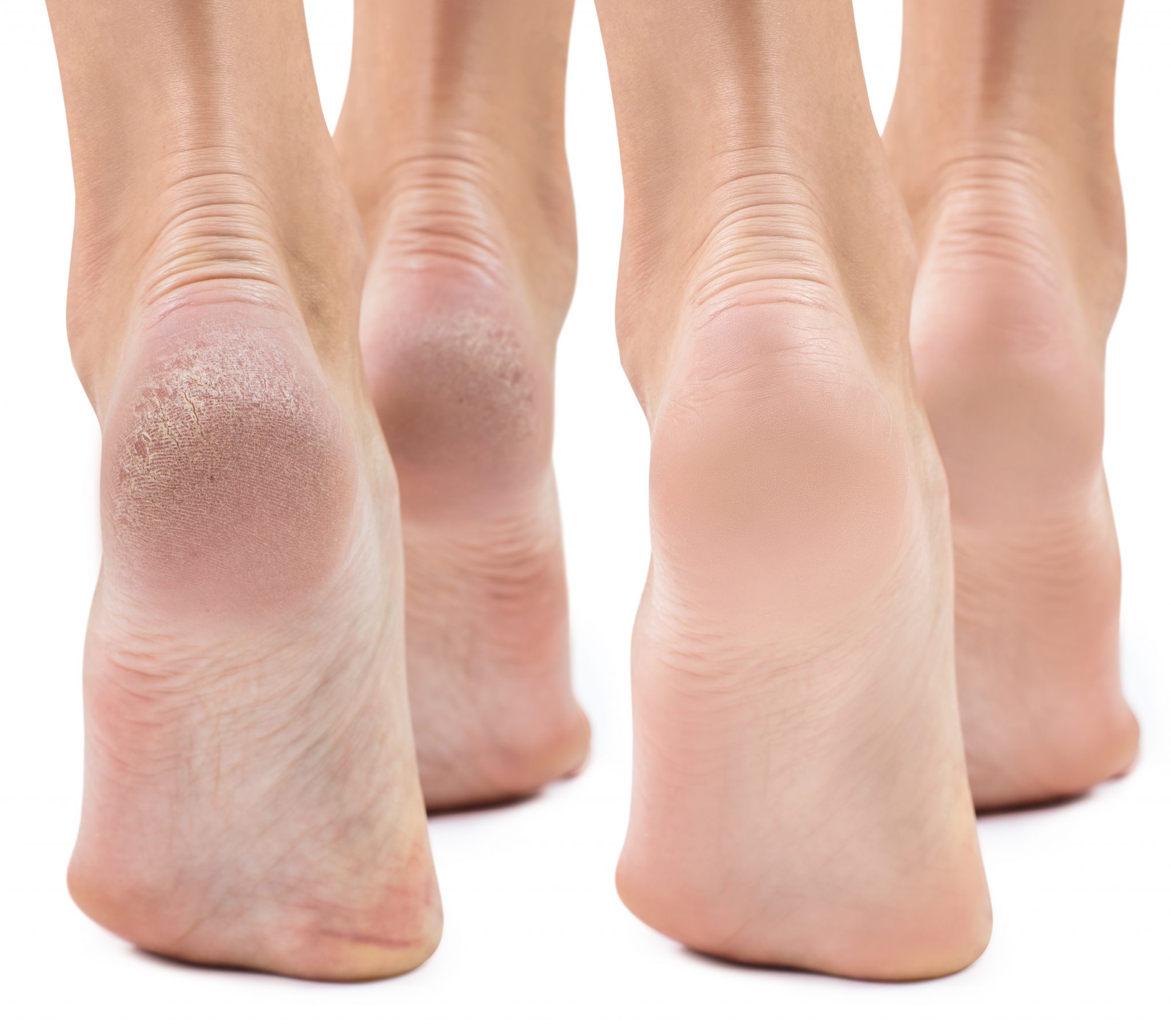 Foot Eczema vs Athlete's Foot
