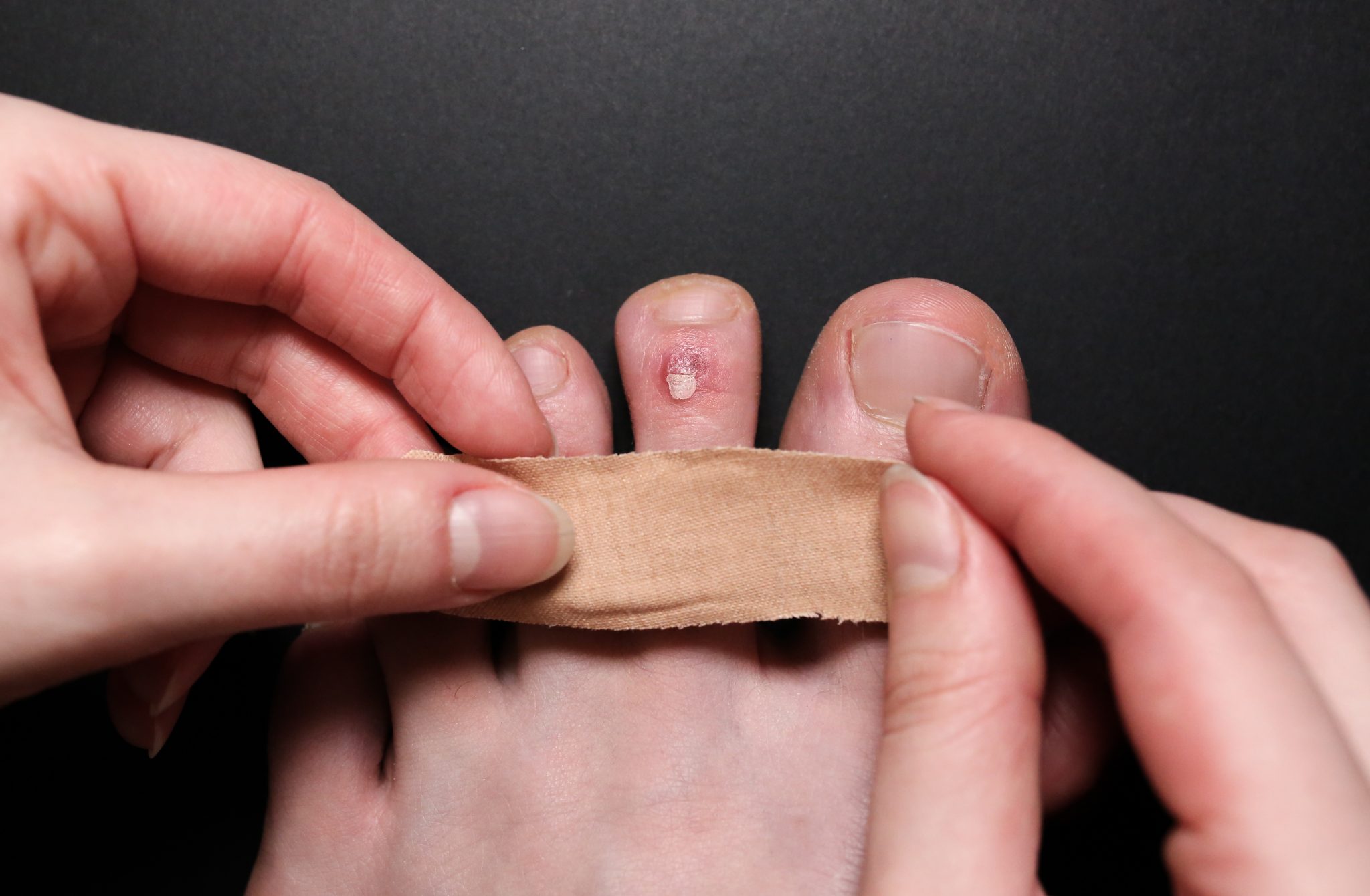 CALLUS REMOVAL AT HOME! SO SATISFYING! 