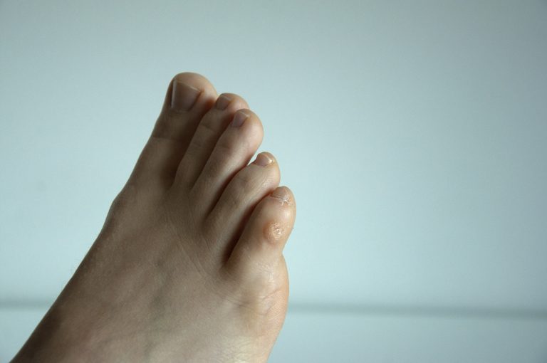 What’s the Difference Between Foot Corns vs Foot Calluses? Foot and Ankle Group