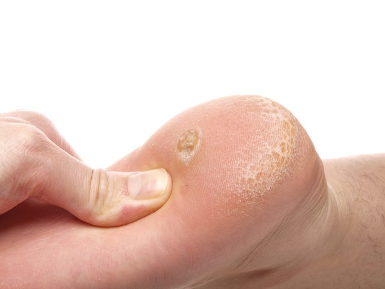 What’s the Difference Between Foot Corns vs Foot Calluses? - Foot and ...