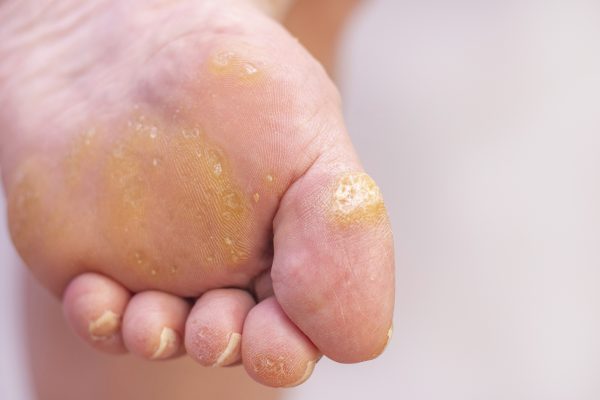 How to Safely Remove a Foot Wart at Home