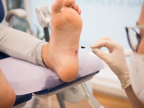 How to Safely Remove a Foot Wart at Home