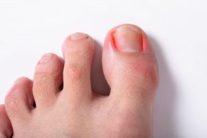Symptoms and signs of ingrown toenail issues include redness on the skin or under the toenail.
