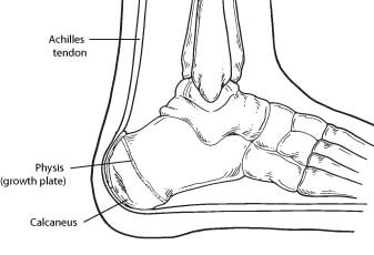 Calcaneal Apophysitis can be a cause of foot and heel pain in children.