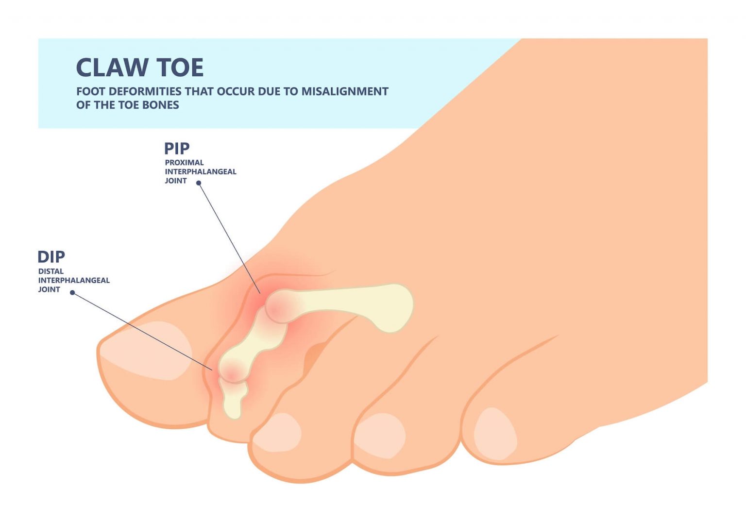 Hammer, Mallet, and Claw Toe Deformities What's the Difference? Foot and Ankle Group