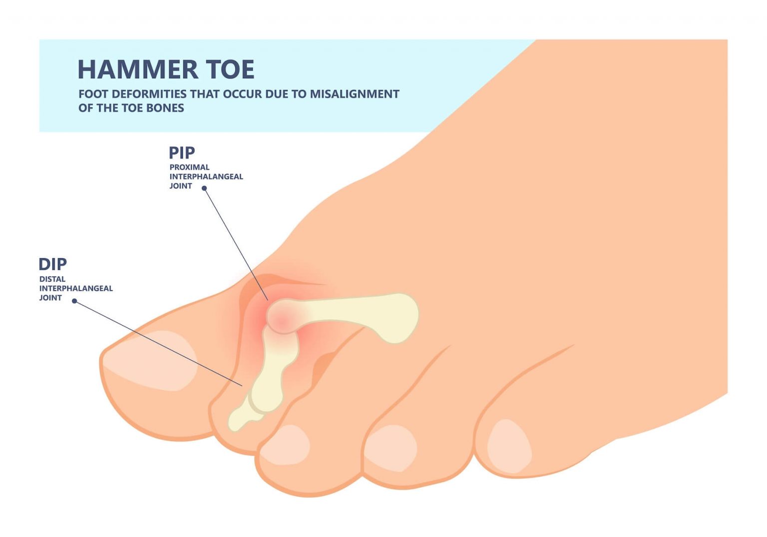 Hammer, Mallet, and Claw Toe Deformities What's the Difference? Foot and Ankle Group