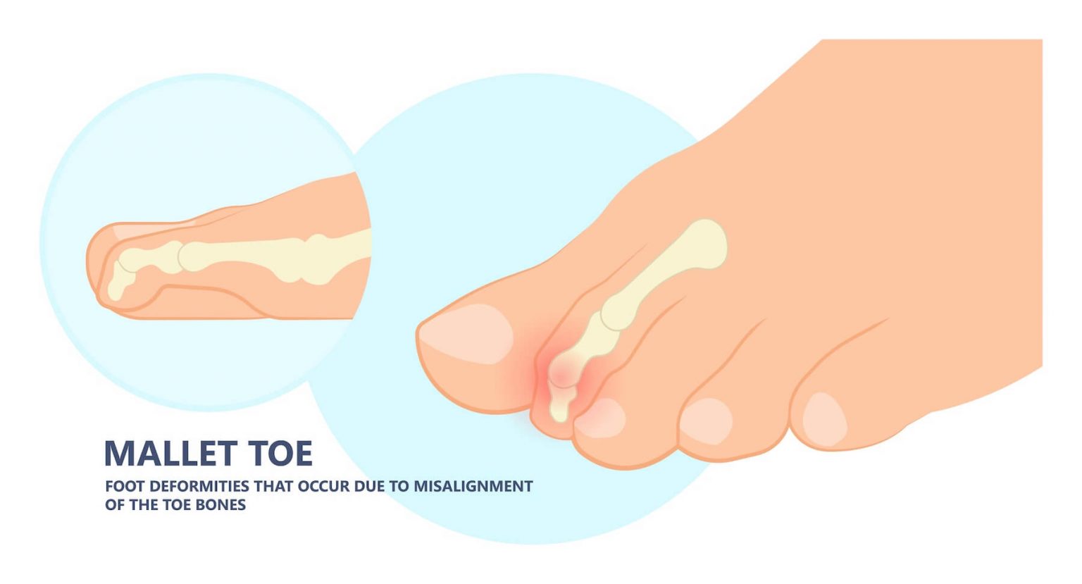 Hammer, Mallet, and Claw Toe Deformities What's the Difference? Foot and Ankle Group