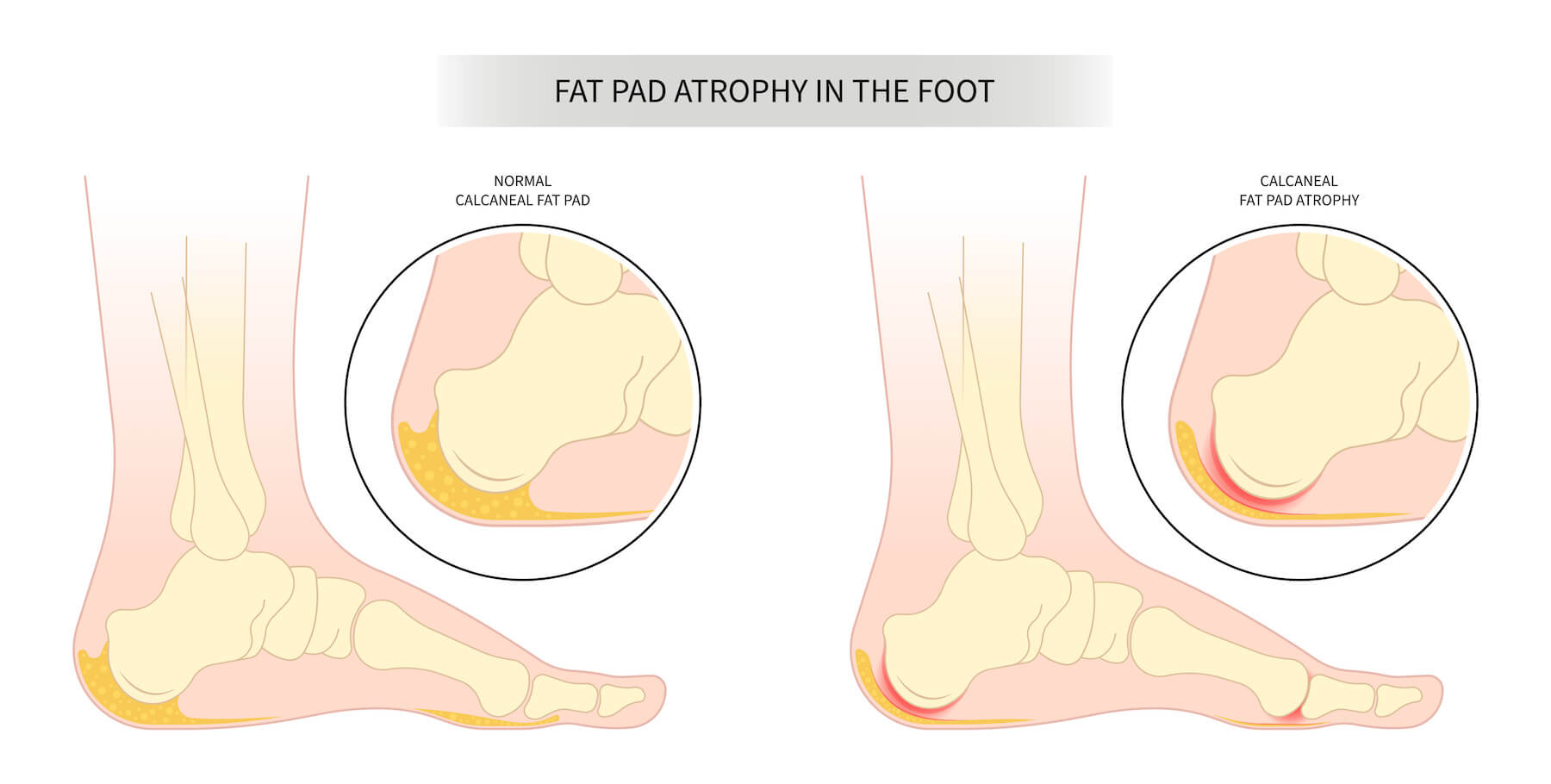 How To Treat Foot Pad Atrophy Foot and Ankle Group