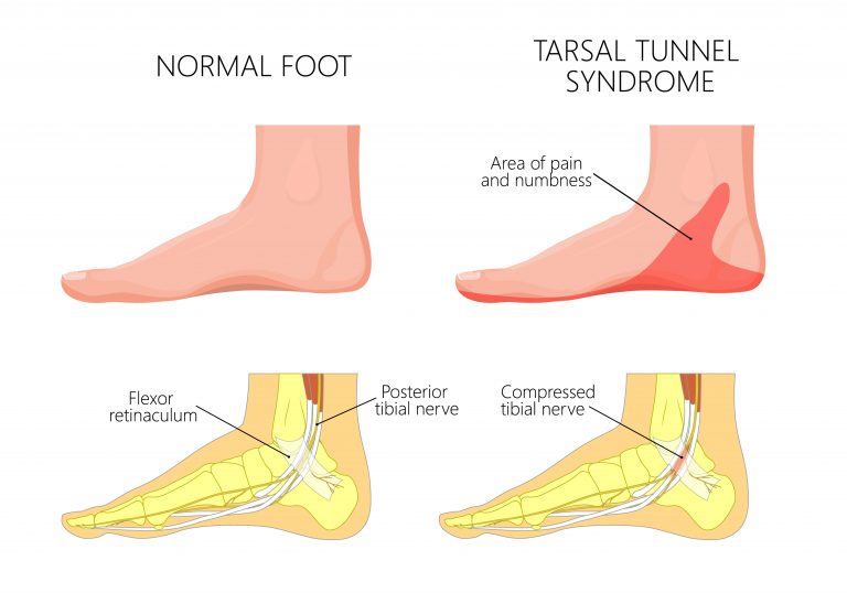 How To Recognize and Treat Tarsal Tunnel Syndrome Foot and Ankle Group